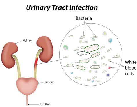 Proteus mirabilis and Urinary Tract Infections .